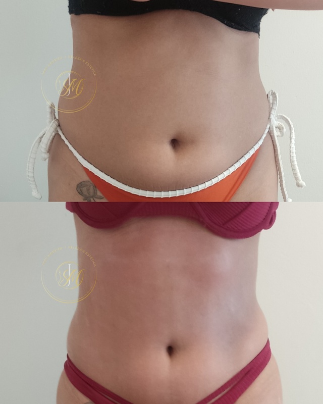 Clínica Estética - Josy Moreira - Centro de Guarulhos- LIMPEZA DE PELE - TRATAMENTO GORDURA LOCALIZADA -MASSAGEM RELAXANTE