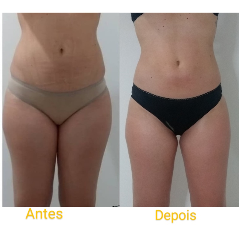 Clínica Estética - Josy Moreira - Centro de Guarulhos- LIMPEZA DE PELE - TRATAMENTO GORDURA LOCALIZADA -MASSAGEM RELAXANTE - Clínica de Estética em Centro, Guarulhos/SP - Foto 4